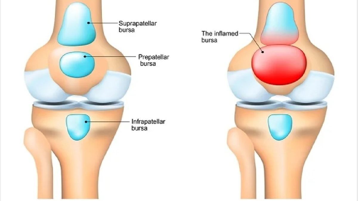 How Many Types Of Bursitis Are There?