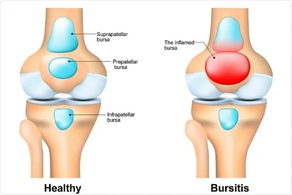 How Many Types Of Bursitis Are There