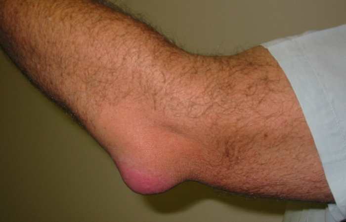 Bursitis